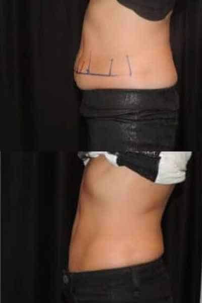 HIEMT Muscle Toning Frimley