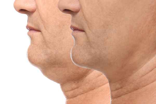 HIFU - Breakthrough in Anti - ageing 2 hifu results Frimley