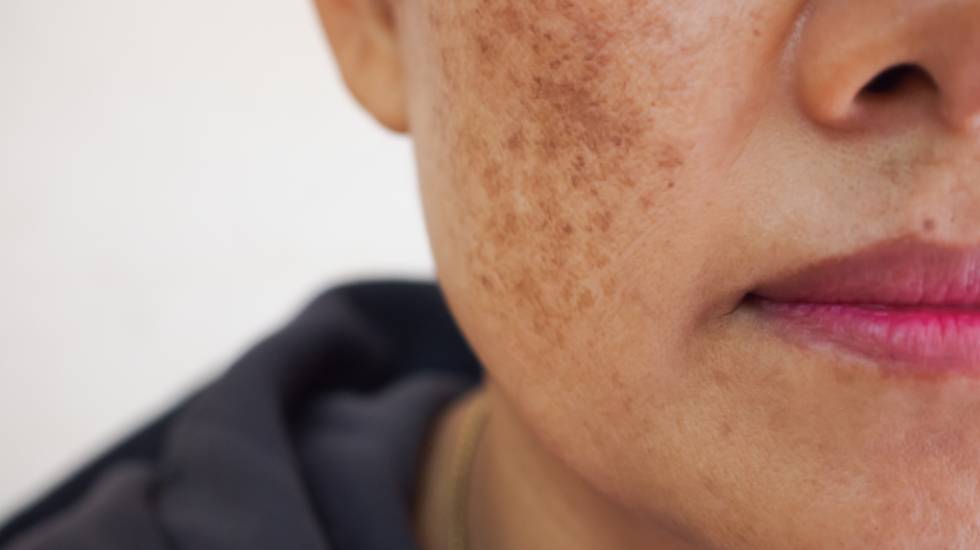 Ephelides Treatment Frimley