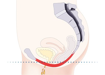 Pelvic-Floor Muscle Repair 5 Pelvic floor muscles Frimley
