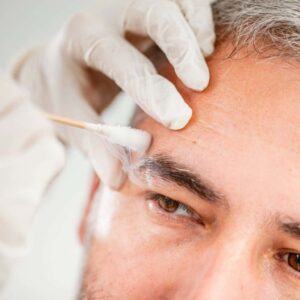 What Does Solar Lentigines Treatment Do?