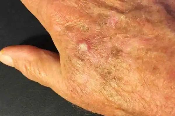 Cryopen For Actinic Keratoses 1 Image of Actinic keratoses Frimley on a person hand