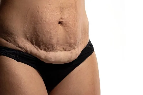 The Science of Skin Tightening 1 The science behind skin tightening Frimley picture of a woman's sagging skin on the stomach